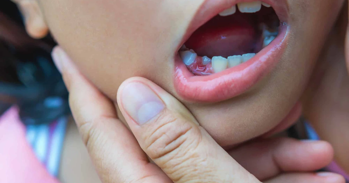Dreams Of Teeth Falling Out